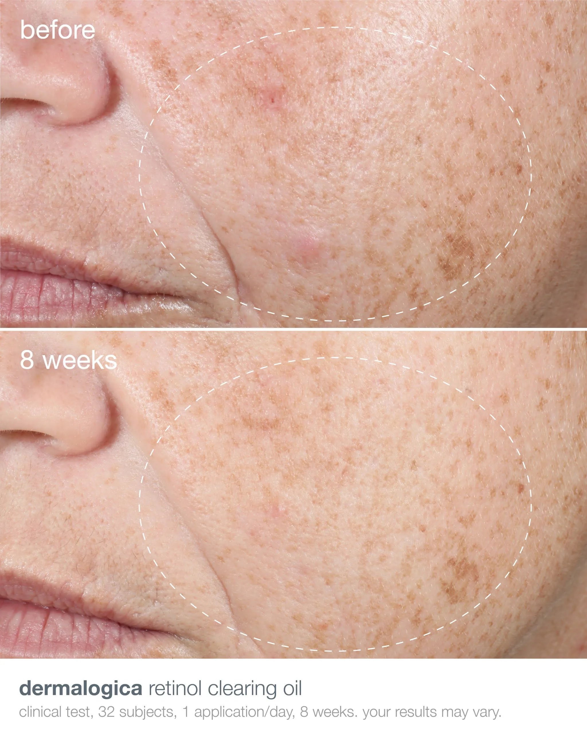 retinol acne clearing oil